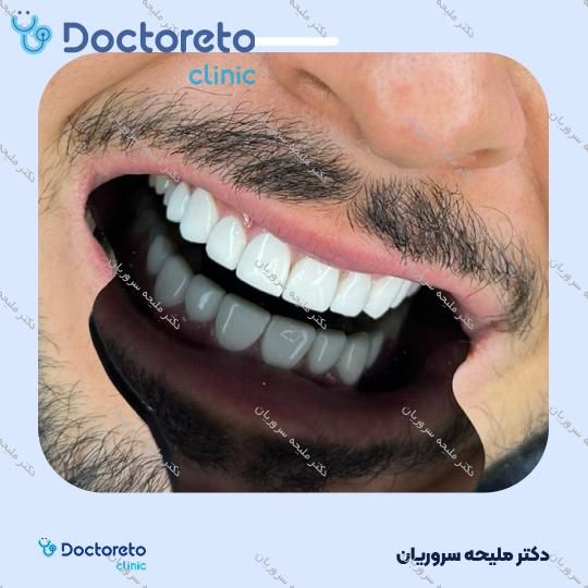 ونیر کامپوزیت (هر واحد)
