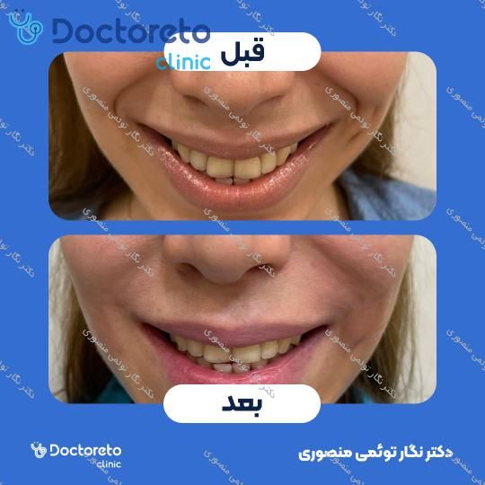 تزریق ژل خط خنده با برند نورامیس (1CC)