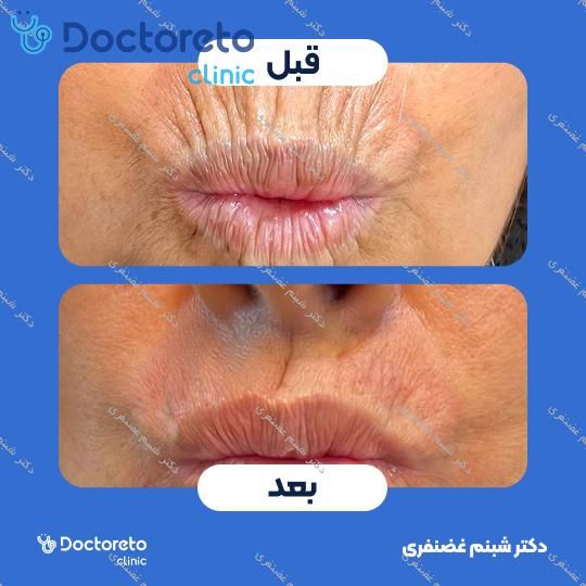 تزریق بوتاکس صورت