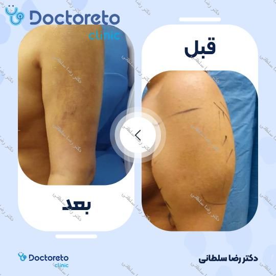 لیپوماتیک بازو ها