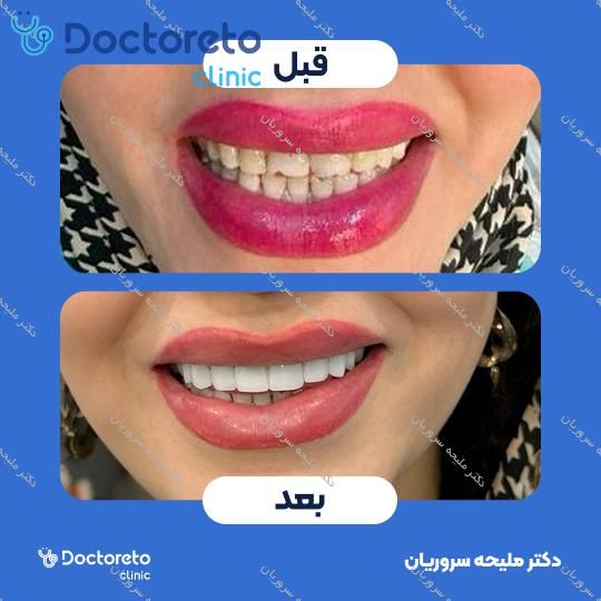 لمینت سرامیکی دندان