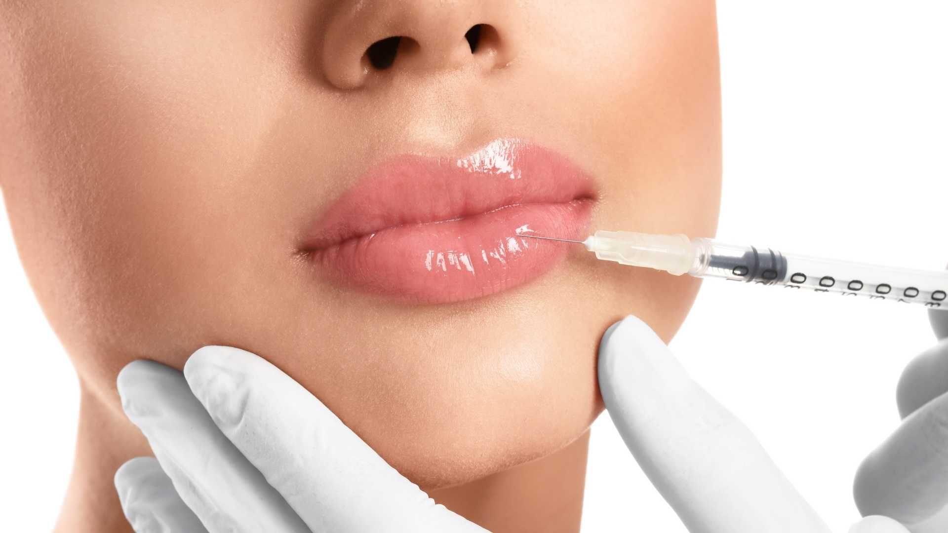 تزریق ژل خط خنده