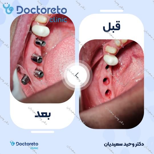 ایمپلنت با روکش زیرکونیوم (هر واحد)