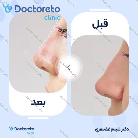 تزریق ژل بینی