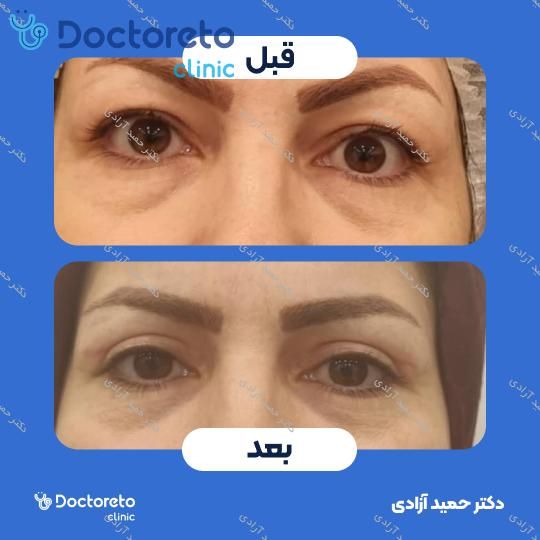 بلفاروپلاستی به روش جراحی