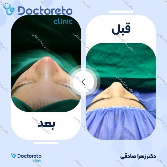 عمل زیبایی بینی (رینوپلاستی)