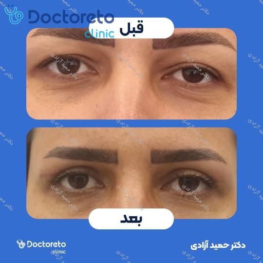بلفاروپلاستی به روش جراحی