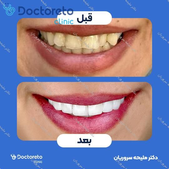 لمینت سرامیکی دندان