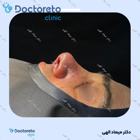 عمل زیبایی بینی با بیهوشی (رینوپلاستی)
