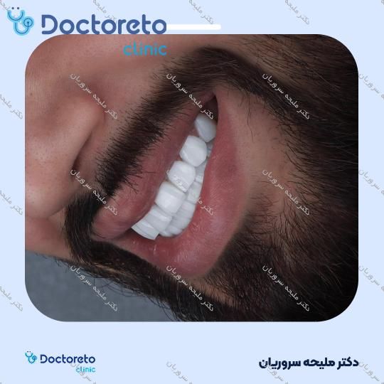 ونیر کامپوزیت (هر واحد)