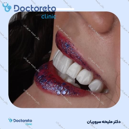 ونیر کامپوزیت (هر واحد)
