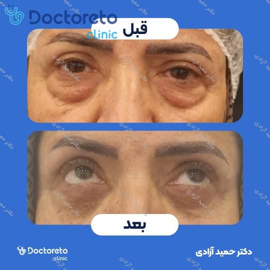 بلفاروپلاستی به روش جراحی