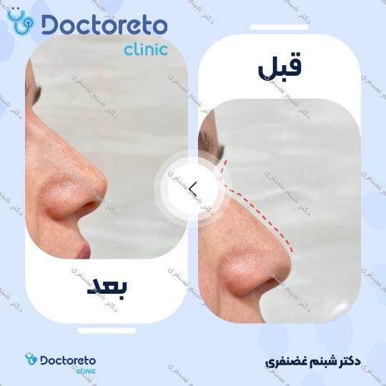 تزریق ژل بینی