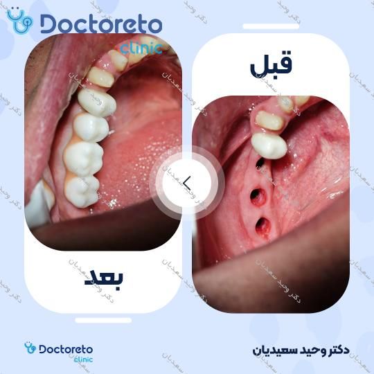 ایمپلنت با روکش زیرکونیوم (هر واحد)