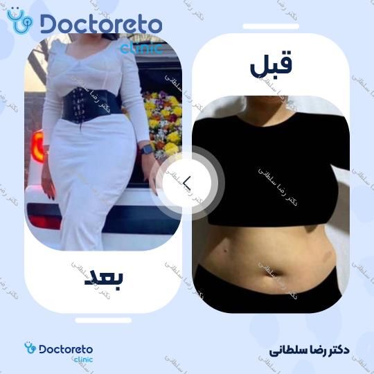 لیپوماتیک شکم و پهلو ها و پشت