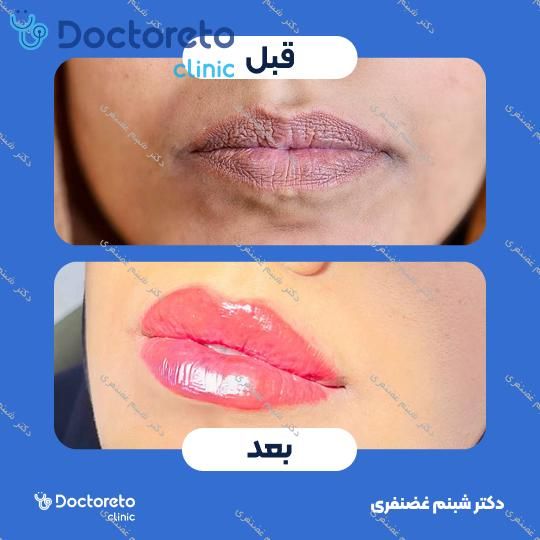 تزریق ژل لب