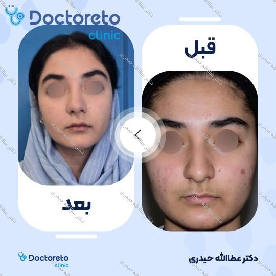 عمل جراحی مجدد زیبایی بینی (رینوپلاستی)