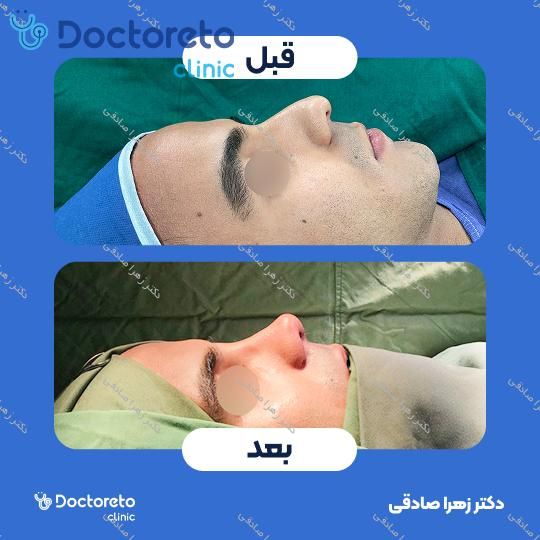 عمل جراحی مجدد زیبایی بینی (رینوپلاستی)