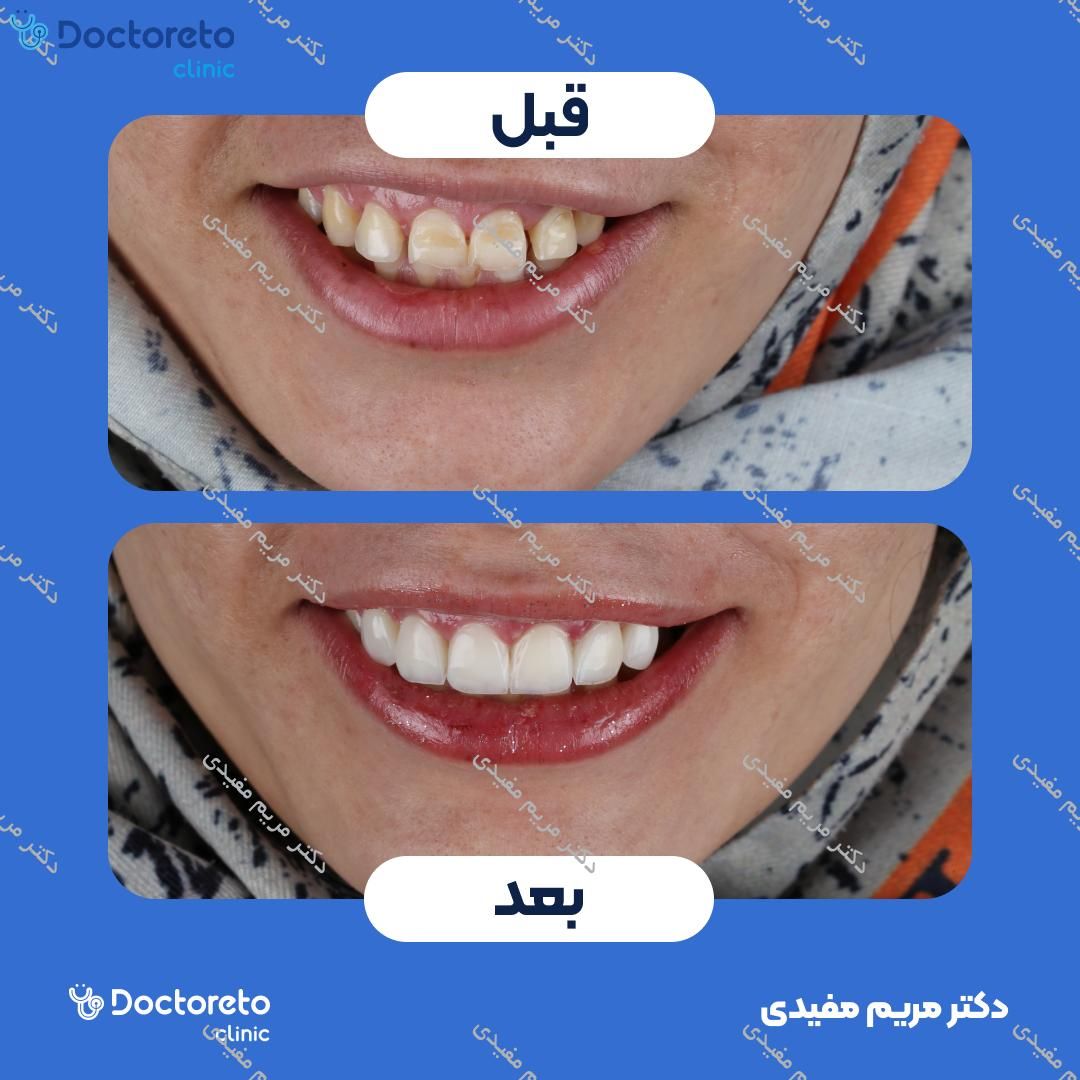 ونیر کامپوزیت دندان (هرواحد)