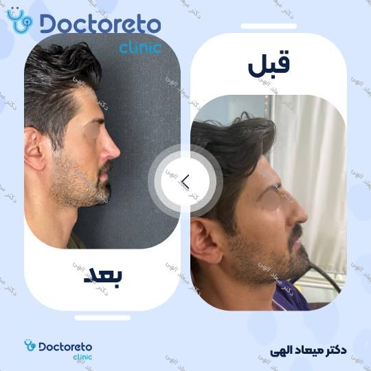 عمل زیبایی بینی با بیهوشی (رینوپلاستی)