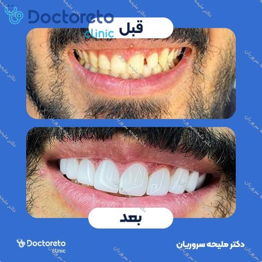 ونیر کامپوزیت (هر واحد)