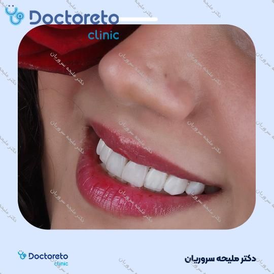 ونیر کامپوزیت (هر واحد)