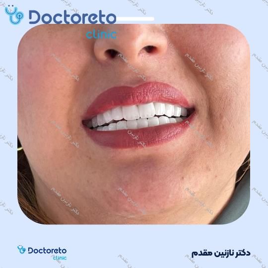 ونیر کامپوزیت دندان (هرواحد)
