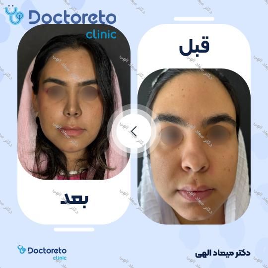 عمل جراحی مجدد زیبایی بینی (ترمیمی)