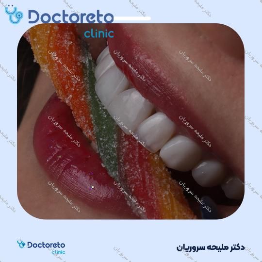 ونیر کامپوزیت (هر واحد)
