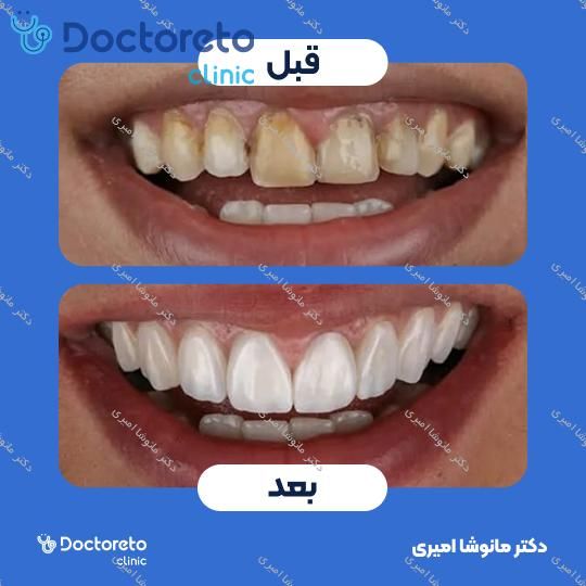 ونیر کامپوزیت (هر واحد)