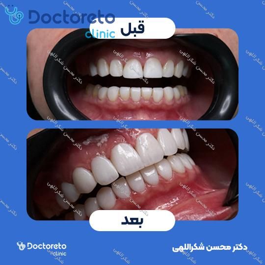 جرمگیری دو فک با بروساژ