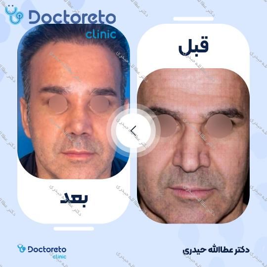 عمل جراحی مجدد زیبایی بینی (رینوپلاستی)
