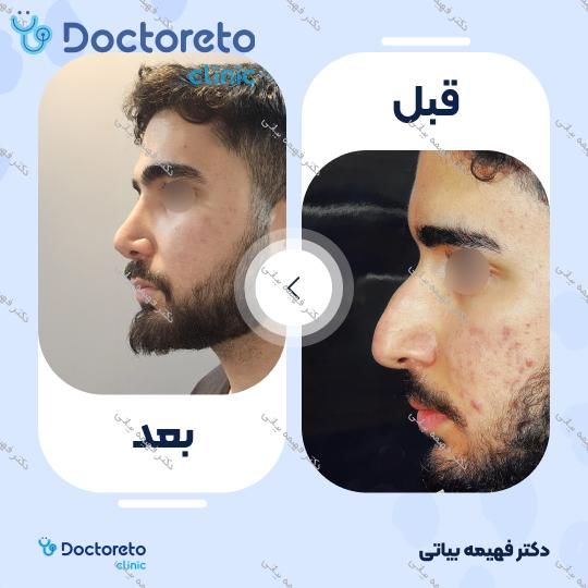 جراحی انحراف بینی (سپتوپلاستی)