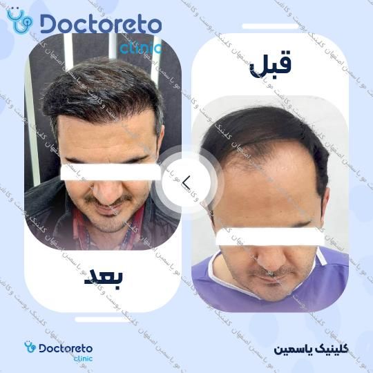 کاشت مو به روش FIT