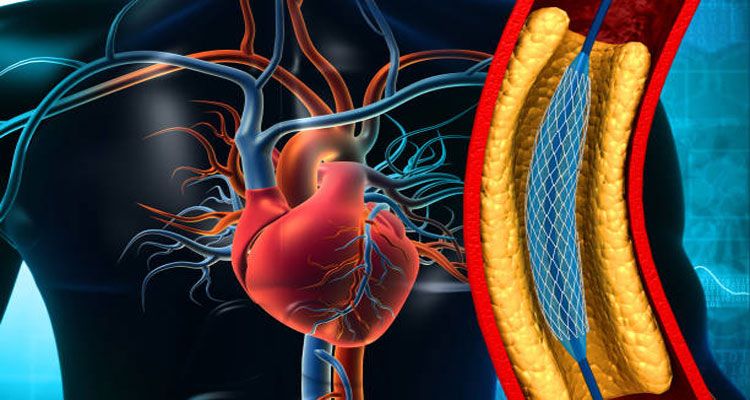 تست ABI و غربالگری بیماری های عروقی