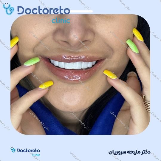 ونیر کامپوزیت (هر واحد)