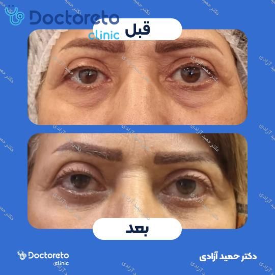 بلفاروپلاستی به روش جراحی