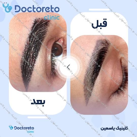 کاشت ابرو