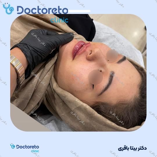 جوانسازی صورت با مزوژل