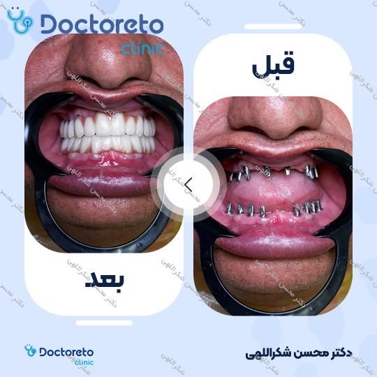جرمگیری دو فک با بروساژ