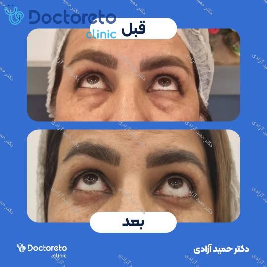 بلفاروپلاستی به روش جراحی