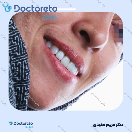 لمینت سرامیکی دندان (هر واحد)