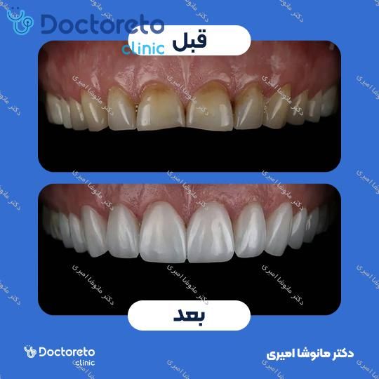ونیر کامپوزیت (هر واحد)