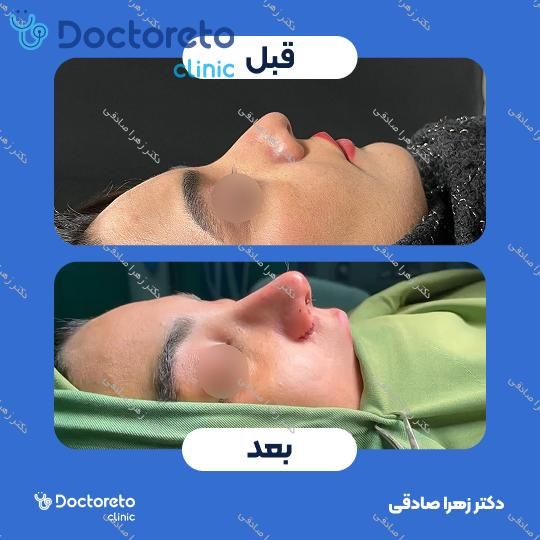 جراحی انحراف بینی (سپتوپلاستی)