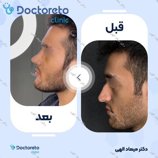 عمل جراحی مجدد زیبایی بینی (ترمیمی)