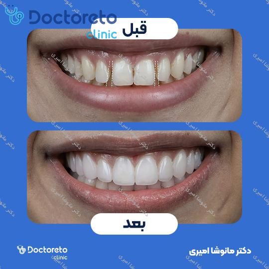 ونیر کامپوزیت (هر واحد)