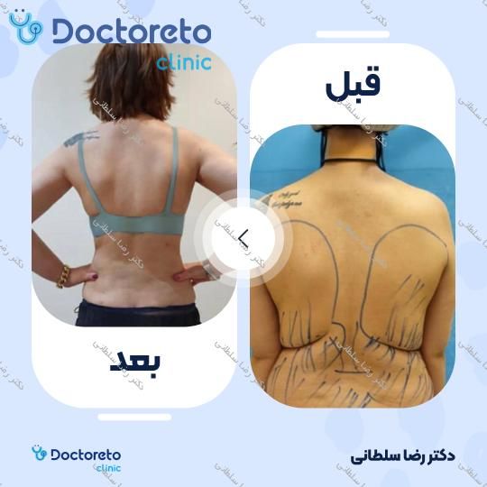 لیپوماتیک شکم و پهلو ها و پشت