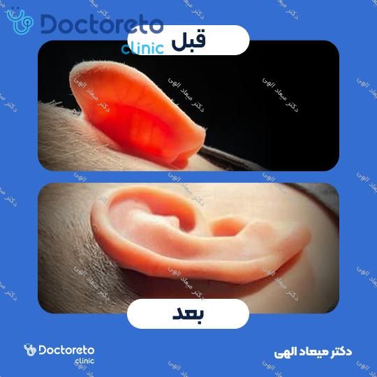 عمل زیبایی گوش (اتوپلاستی)