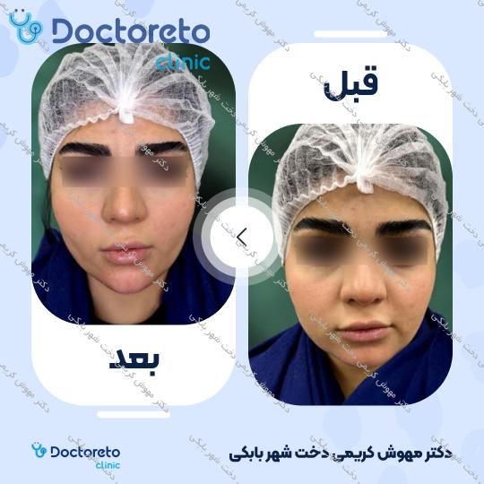 تزریق ژل چانه با برند EPTQ (هر سی سی)