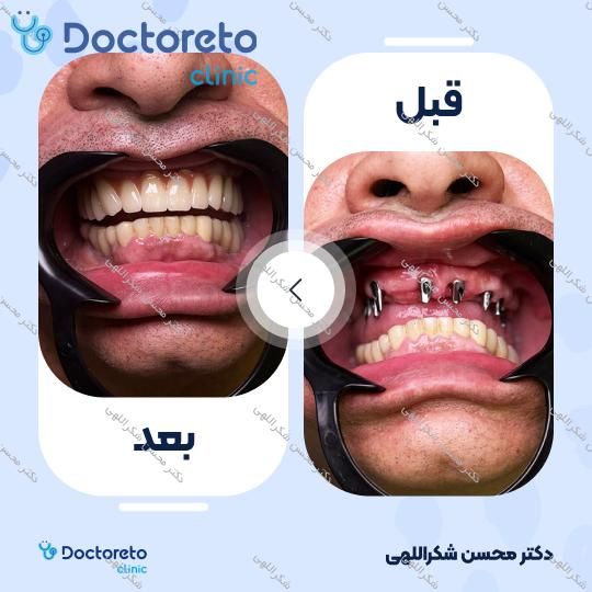 جرمگیری دو فک با بروساژ